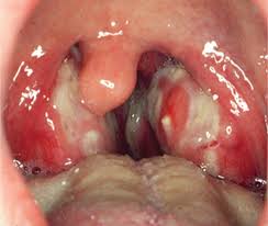 Infektiöse mononukleose, auch pfeiffersches drüsenfieber genannt, ist eine ansteckende krankheit. Figure 5 Rachenentzundung Tonsillitis Oder Pharyngitis Springerlink