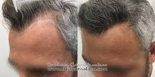 Fra il quinto e il sesto mese post operatorio il paziente potrà notare una ricrescita consistente, i nuovi capelli saranno approssimativamente lunghi dai cinque . Caso N 18 Trapianto Fue Parzialmente Rasato Insalaco Clinic