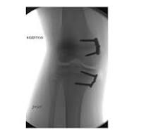 Hinge Pediatric Plating System™ - OrthoPediatrics