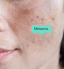 Image result for Melasma