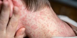 Image result for measles