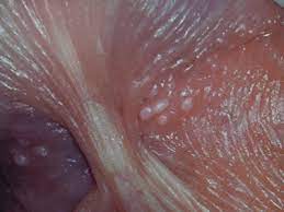 Racgp - Penile Appearance, Lumps And Bumps