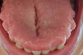 Image result for Fissured tongue