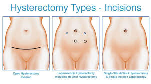 Pin On Hysterectomy