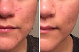 In general, we often say that elevated blood pressure (>140 systolic or >90 diastolic) is asymptomatic. Reduce Redness On Face Overnight How To Get Rid Of Redness On Face The Most Effective Natural Ways 2020 01 01