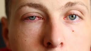 Berhenti menggosok mata menggosok mata dalam keadaan sakit mata sangatlah berbahaya, hal ini. Sering Main Gadget Mata Anak Sering Merah Dan Berair Apakah Berbahaya Tribun Kaltim