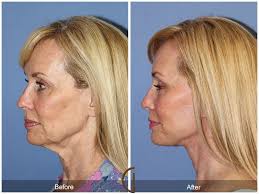 Before Amp After Orange County Facelift 115 Orange County Newport Neck Liposuction Liposuction Plastic Surgery