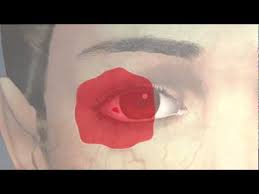 La Hemorragia Subconjuntival Ojo Rojo Youtube