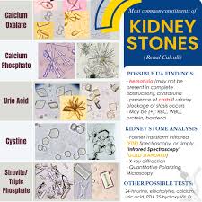 Image result for Calcium Nephrolithiasis