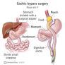 gastric bypass surgery from my.clevelandclinic.org