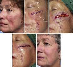 Scar Deformities