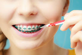 Mark norey, cpt in crash course (april 6, 2016). Dental Braces Their Types And Costs
