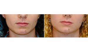 https www drspiegel com facial feminization surgery boston ffs procedures mandible contouring facial feminization surgery cosmetic surgery facial muscles