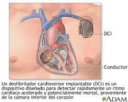 Un desfibrilador cardioversor implantable se coloca quirúrgicamente debajo de la piel debido a que el desfibrilador cardioversor implantable controla constantemente los ritmos cardíacos anómalos y. Desfibrilador Cardioversor Implantable Medlineplus Enciclopedia Medica