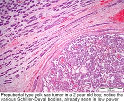 Effect of host, tumor, diagnostic, and treatment variables on outcomes in a large cohort with merkel cell carcinoma. Pathology Outlines Yolk Sac Tumor