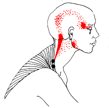 Namtpt Myofascial Trigger Point Therapy What Is It