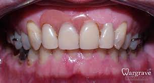 Losing front teeth not only affect your eating habits but also your appearance. Partial Dentures Wargrave Dental Clinic
