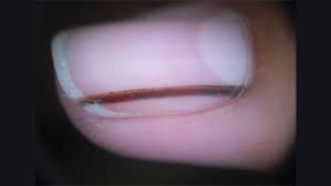 nail black streak causes signs of nail