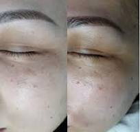 PDRN Rejuvenating Ampoule Eldermafill | Мощная регенерация