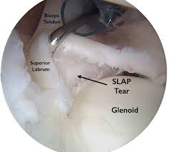 Image result for SLAP Lesion