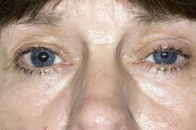 Die augen sind die spiegel der seele—auch oder gerade nach einer durchlebten clubnacht mit nahezu toxischem während sich die pupillen nach der einnahme von beispielsweise kokain, mdma oder. Horner Syndrom Storungen Der Hirn Ruckenmarks Und Nervenfunktion Msd Manual Ausgabe Fur Patienten