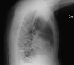 Image result for Air Bronchogram