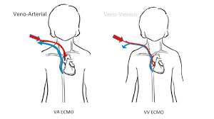People who need support from an how does an ecmo machine work? Extracorporeal Membrane Oxygenation Ecmo In Infants Children