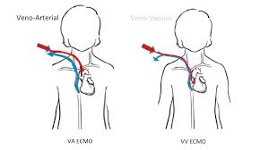 Ecmo treatments like novalung oxygenate a patient's blood through an artificial lung and circulate the future growth areas for ecmo devices are in the use cases. Extracorporeal Membrane Oxygenation Ecmo In Infants Children