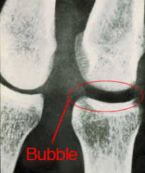 Image result for Decompression Sickness