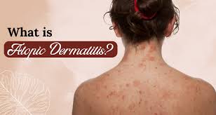 Image result for Atopic Dermatitis