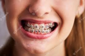 The exact amount you pay will probably depend on unless a charity dental programme pays for one for you, there is really no clinic i can think of that'd let you get a dental treatment for free. Rban1brgpfzoum