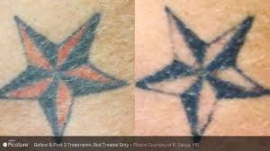 If so, you're not the only one. Laser Tattoo Removal Before After Photos Winston Salem Nc