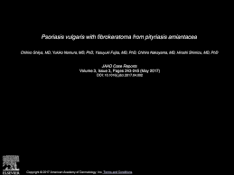 Pityriasis amiantacea is a condition in which there is excessive scaling of the scalp. Psoriasis Vulgaris With Fibrokeratoma From Pityriasis Amiantacea Ppt Download