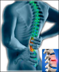 Osteochondrosis tulang belakang toraks dan lumbar; Apa Yang Dimaksudkan Dengan Slip Disc Physiomobile My