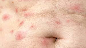 Image result for mite bites on humans