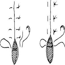 The advantages of the vertical mattress suture are that it provides closure for both deep and superficial layers, and also allows perfect eversion and vertical opposition of the superficial skin edges. Vertical L And Horizontal R Suture Results In Eversion Of Tissues Mattress Box Springs Sutures Ultra Violet