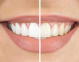 We offer porcelain and composite veneers as well as implants and invisalign and whitening. Cosmetic Dentistry South Carolina Carolina Dental Alliance