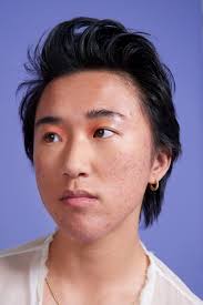 How Abandoning Skin Positivity Affects People With Acne