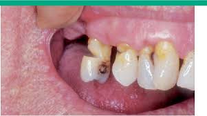 Image result for Tooth Abrasion