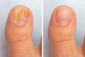Pat your feet dry and apply one or two drops vinegar to your toenail. Nail Fungus Treatment Causes And Prevention