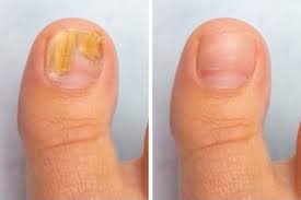 Learn about the symptoms, complications, how the condition is treated, and outlook. Guide To Fungus Free Healthy Nails