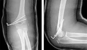 Although medial epicondylitis is referred to as golfer's elbow, it doesn't only affect golfers. Open Reduction And K Wires Fixation Of Medial Humeral Epicondyle Fractures With Intra Articular Elbow Entrapment In Children Massetti Pediatric Traumatology Orthopaedics And Reconstructive Surgery