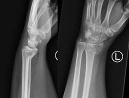 Smith S Fracture Physiopedia