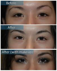 Pin By Caroline Fremont On Eyelid No Eyelid Surgery Double Eyelid Surgery