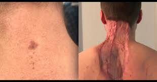 For example, if the cancer begins in the round basal cells below the skin's surface, it's known as basal cell skin cancer. Neck Spot Diagnosed As Skin Cancer Man Warns About Mole