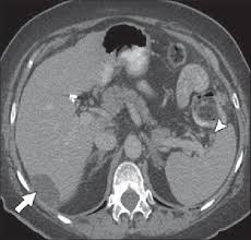 Year Old Woman With Stage Iiic Ovarian Cancer Axial Ct Image Shows Download Scientific Diagram