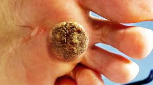 Maybe you would like to learn more about one of these? Worst Plantar Warts Ever Youtube