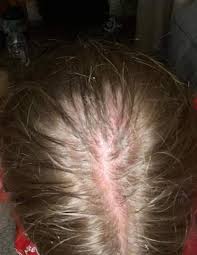 Auch die empfindliche kopfhaut wird dank schützenden sprays behandelt. Kopfhaut Rot Und Brennt Was Tun Gesundheit Und Medizin Gesundheit Haare