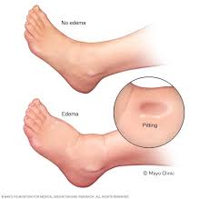 Image result for Localized Edema