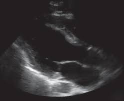 Myocarditis is inflammation of the heart muscle that can be caused by a viral illness. Emergency Medicine News